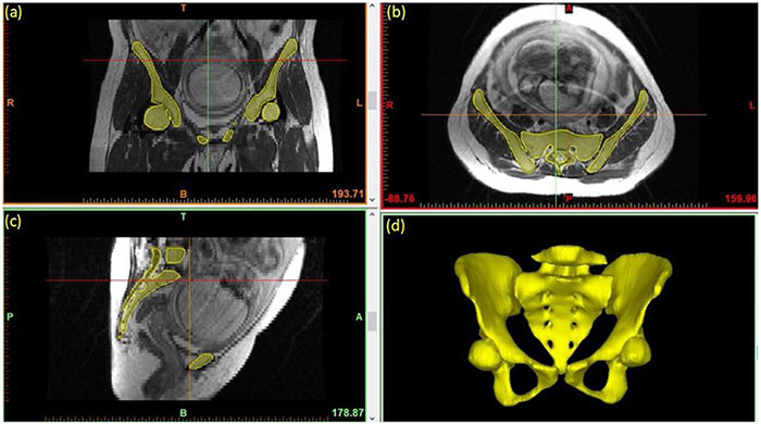 3D Magnetic Resonance Pelvimetry