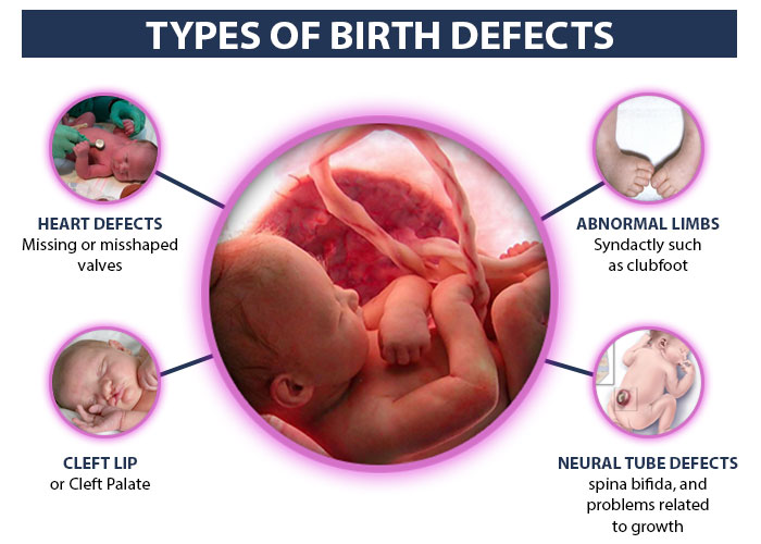 birth defects