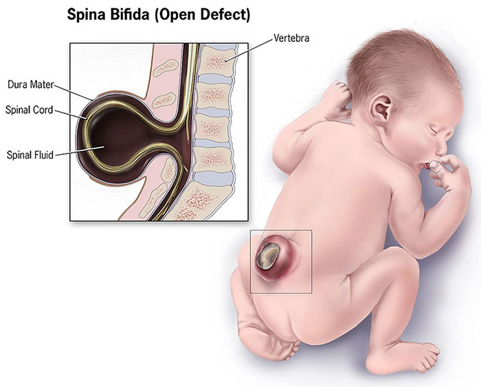 spina bifida