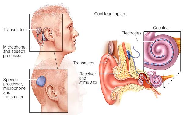 Cochlear Implant for Cerebral Palsy