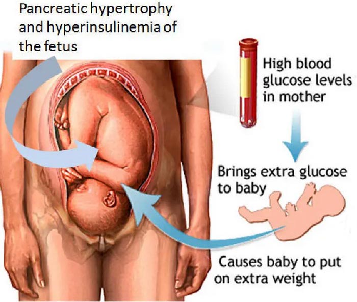 Gestational Diabetes Macrosomia