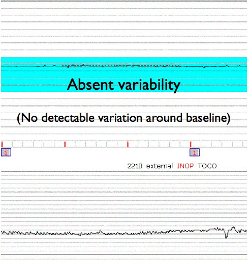 Absent Variability
