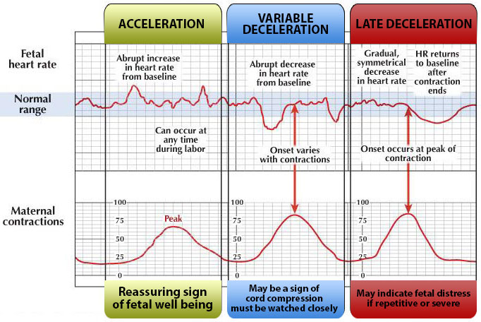 fetal distress heart rates