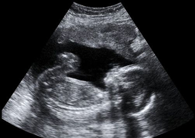 Fetal Ultrasound