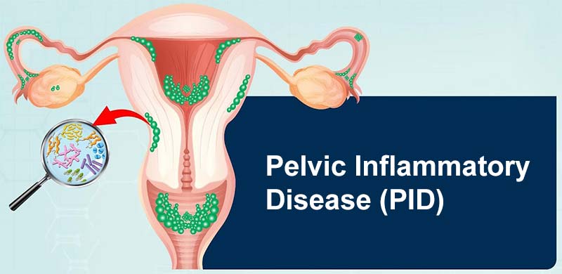 Pelvic Inflammatory Disease