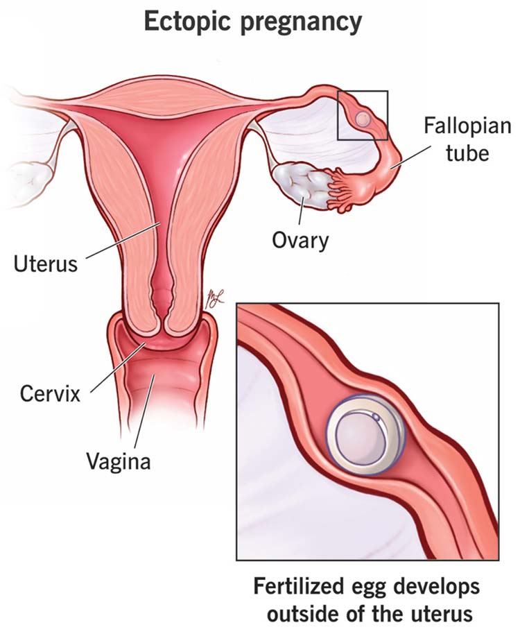 ectopic pregnancy