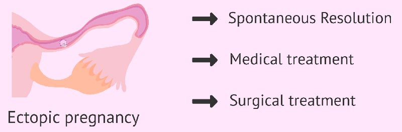 ectopic pregnancy treatment