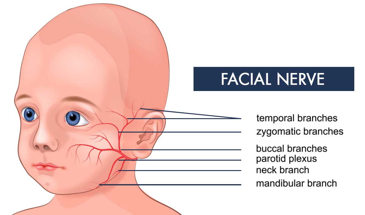 Facial Paralysis in Newborns