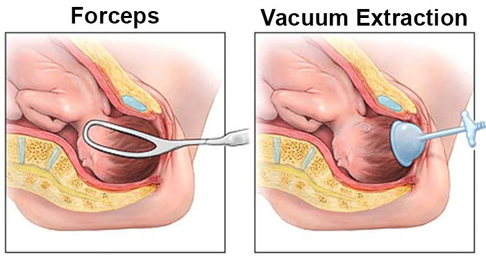 forceps and vacuum extraction injury
