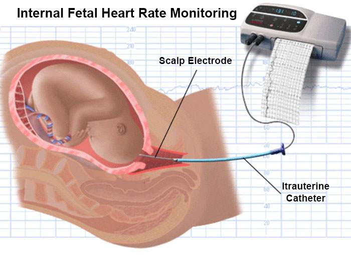 internal fetal monitoring