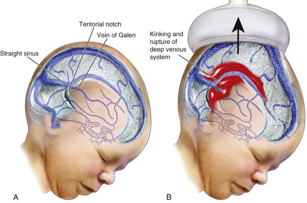Intracranial Hemorrhage By Vacuum Extraction