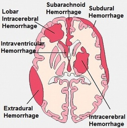 Neonatal Intracranial Hemorrhages