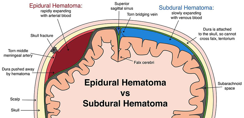 intraventricular hemorrhage