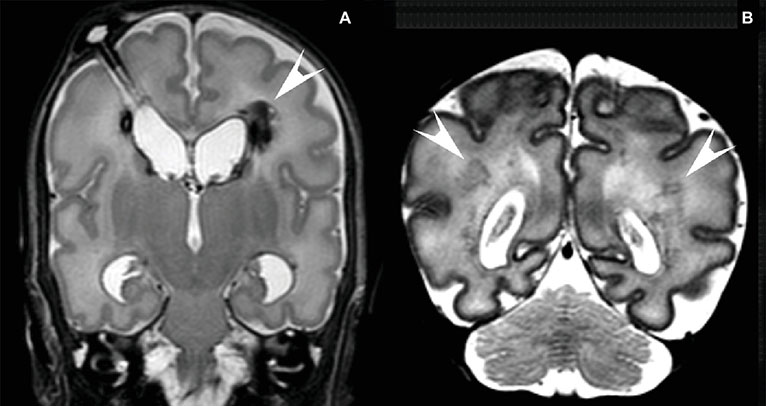 Diagnosing a Neonatal Intracranial Hemorrhage