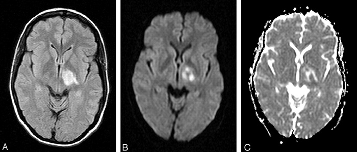 Diffusion Weighted Imaging (DWI)