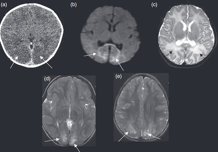 Fetal Brain Abnormalities