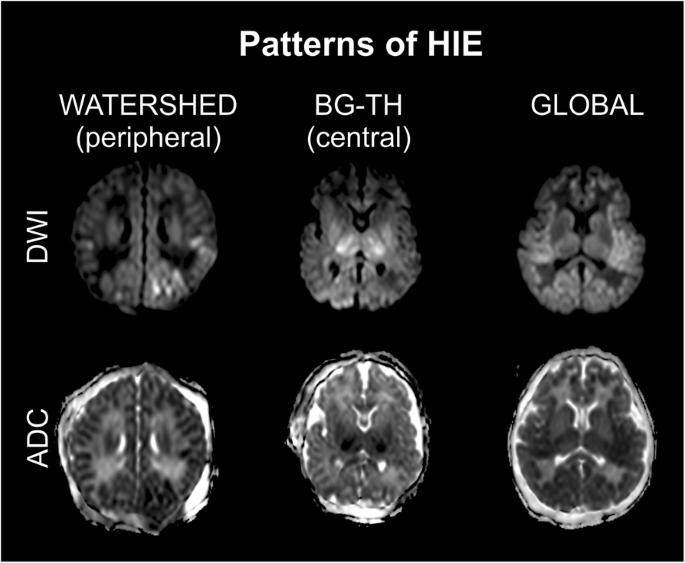 HIE Patterns