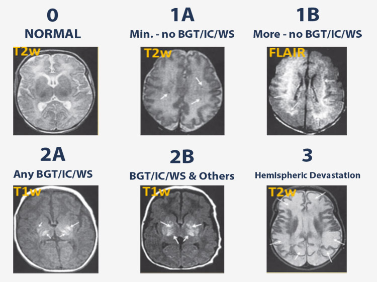 Diffusion Weighted Imaging