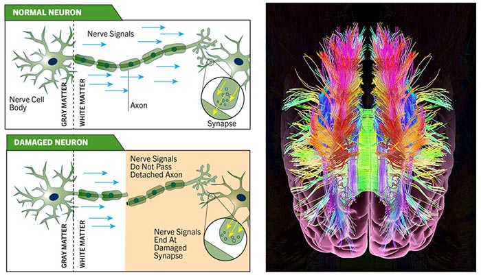 Diffusion Tensor Imaging (DTI)