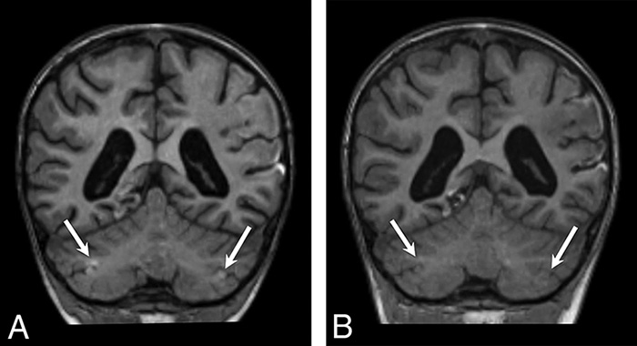 White Matter/Watershed Pattern