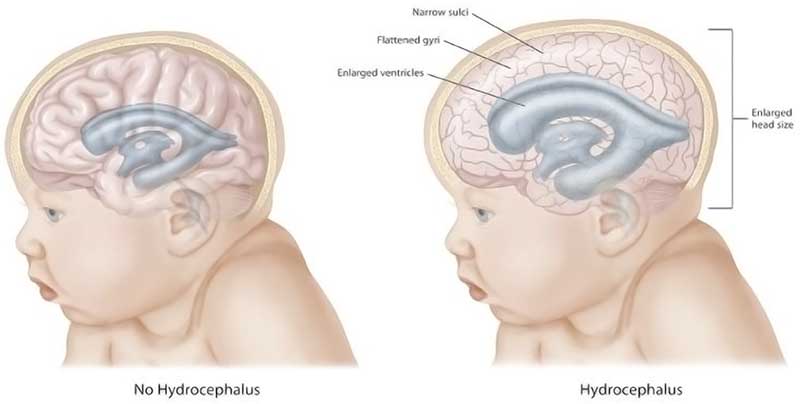 Hydrocephalus