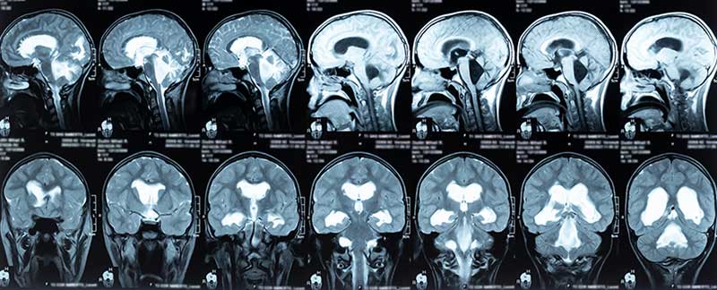 Hydrocephalus Cause Cerebral Palsy