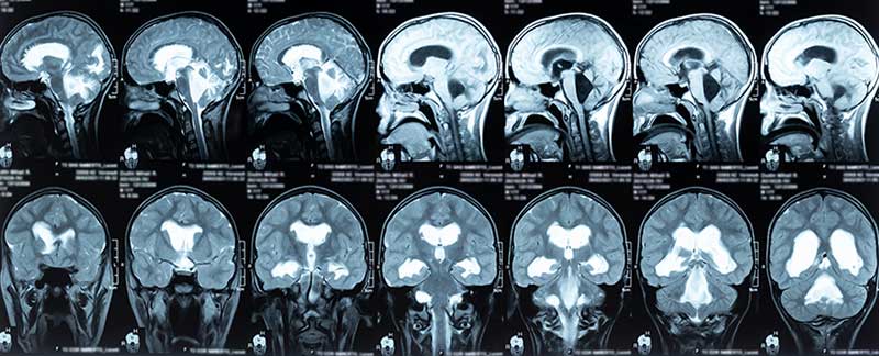 Hydrocephalus Cause Cerebral Palsy