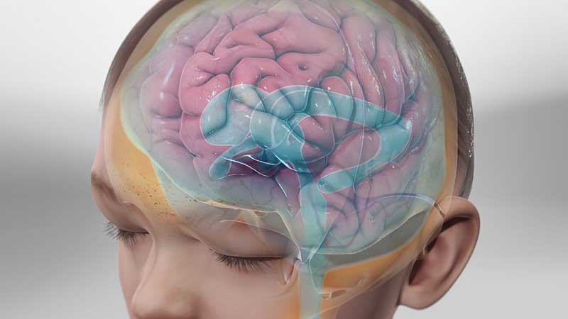 what is Hydrocephalus