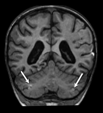 Acute Asphyxia Watershed Affect