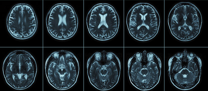 Neuroanatomy for HIE