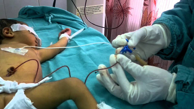 Neonatal Jaundice Transfusion