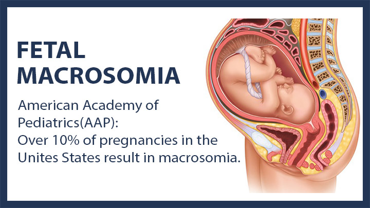 What Is Fetal Macrosomia?