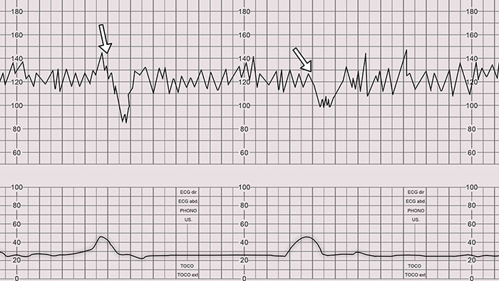 Fetal Heart Rate Monitoring Late Decelerations