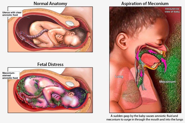 MAS Fetal Distress