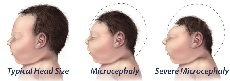 newborn microcephaly