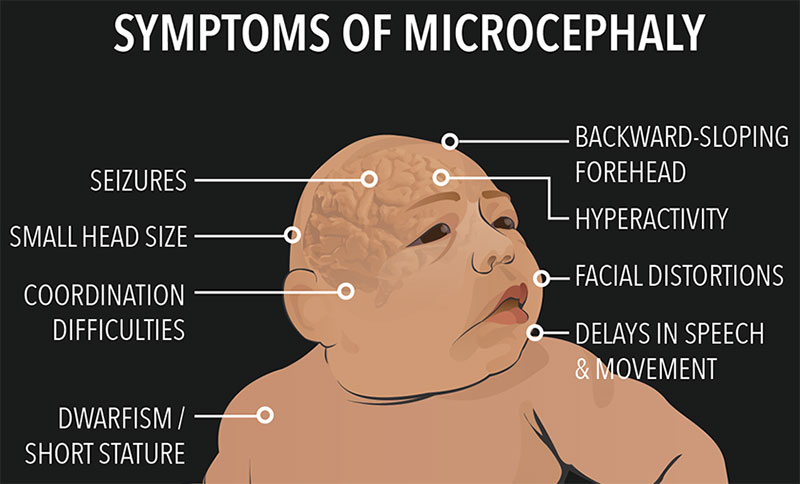 Microcephaly Symptoms