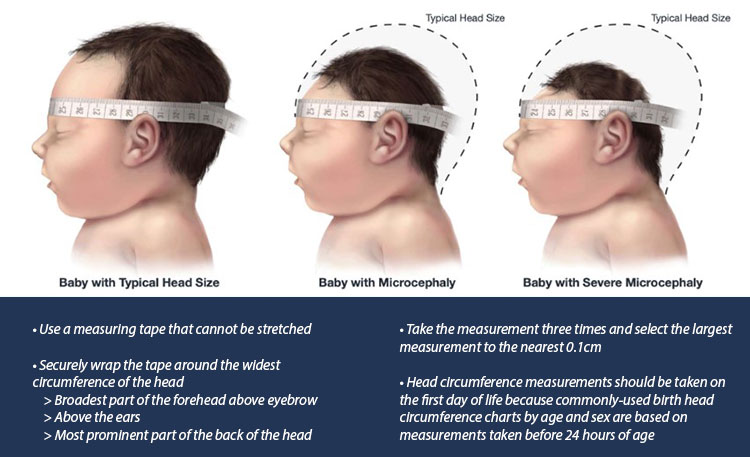 Diagnosing Microcephaly After Birth