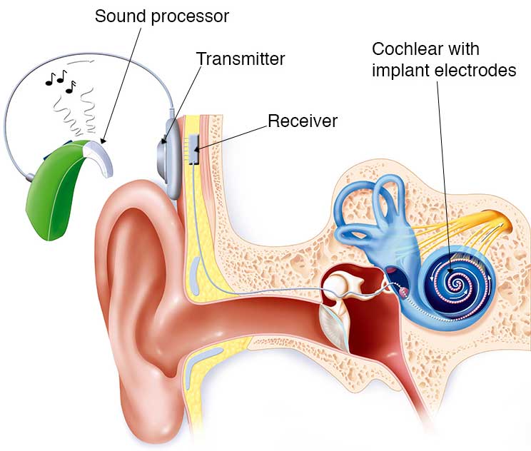 Cochlear Implant