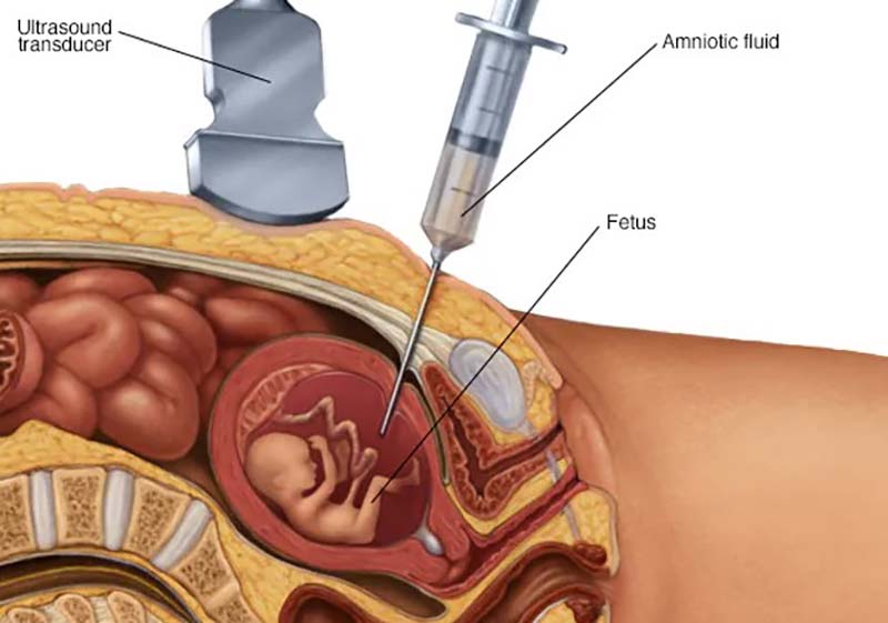 amniocentesis