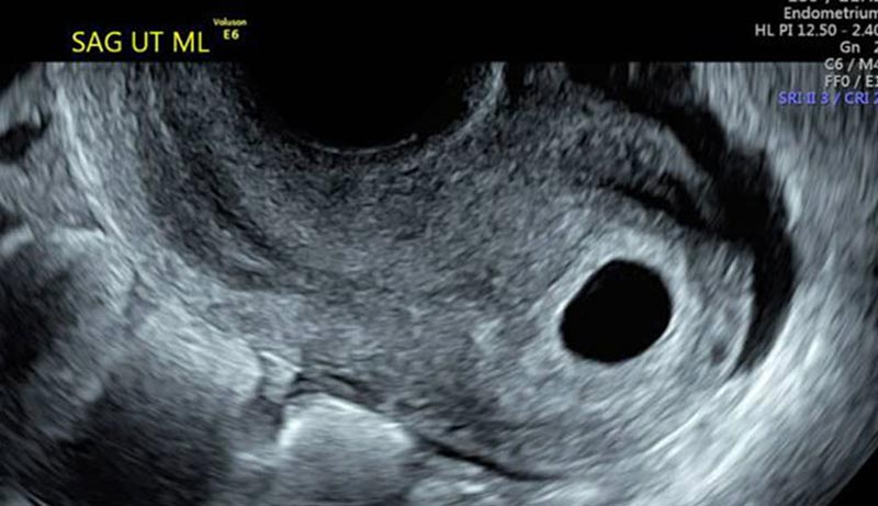 Blighted Ovum During Pregnancy