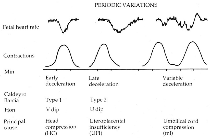 What fetal heart rate monitoring can – and can't – tell us