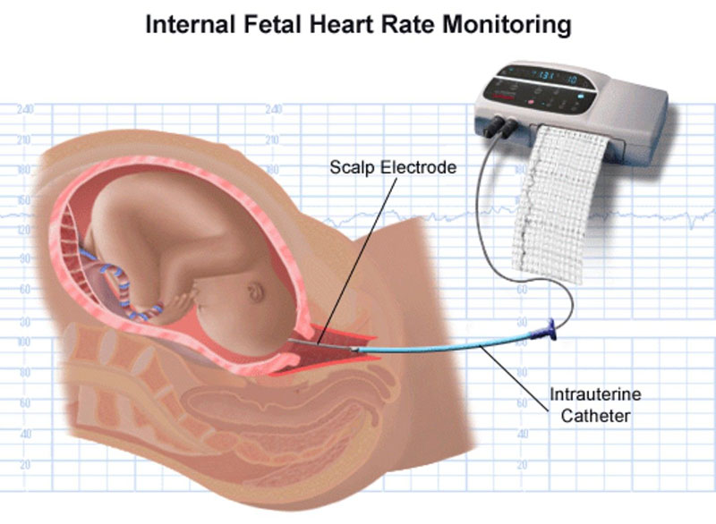 internal monitoing