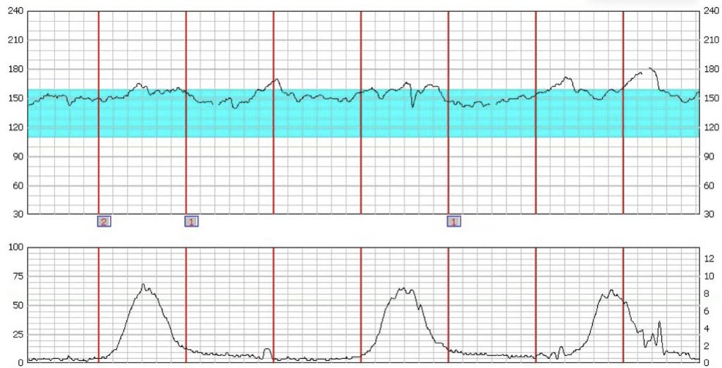 heart rate tracing