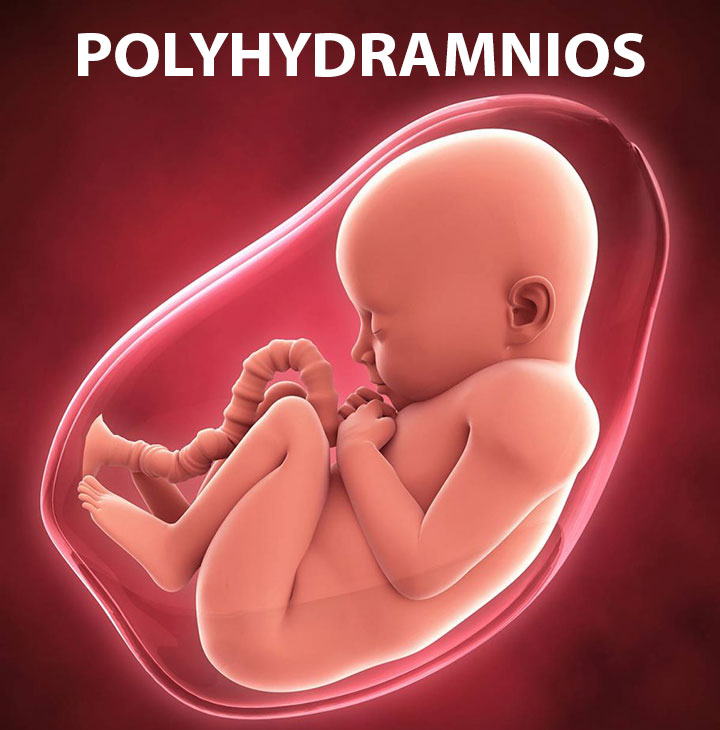 What Is Polyhydramnios?