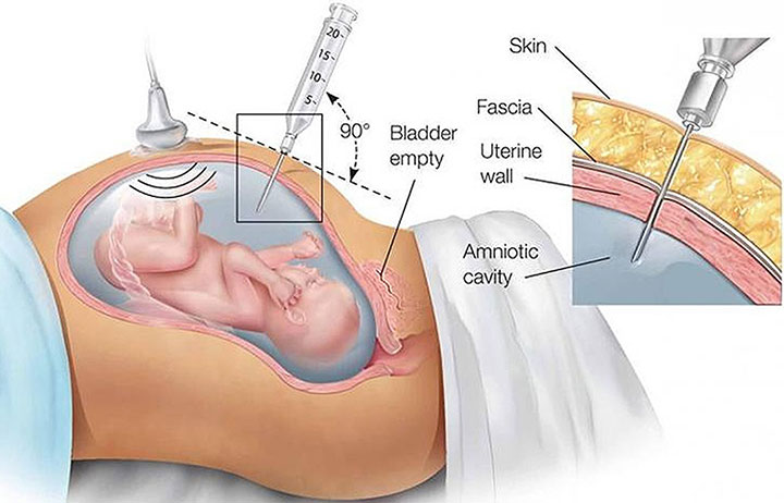 Aminocentesis