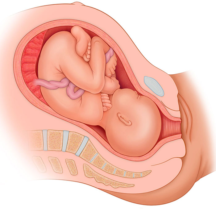 occiput posterior