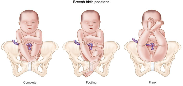 Breech presentations