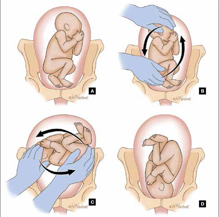 external cephalic version technique