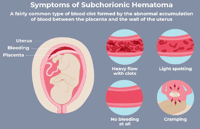 Subchorionic Hematoma