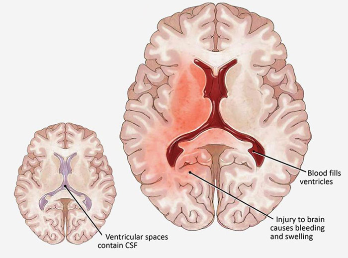 Intraventricular Hemorrhage (IVH) Cross-Section